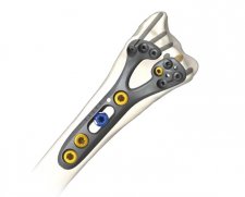 Skeletal Dynamics GEMINUS Volar Distal Radius Plating System | Used in Fracture plating, Plating of distal radius  | Which Medical Device